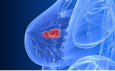 重庆乳腺结节名老中医:乳腺结节是如何引起的?又有哪些症状呢