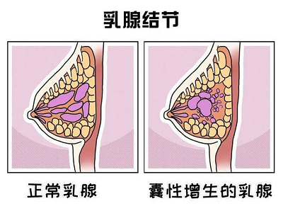 重庆有没有治疗乳腺结节靠谱的老中医?
