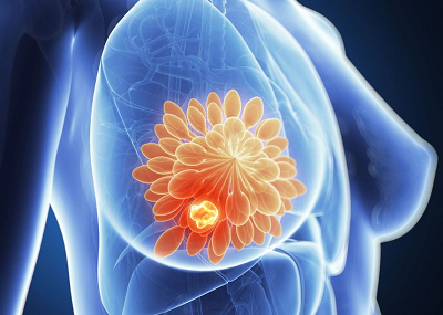 重庆市治疗乳腺癌靠谱的肿瘤老中医是谁?