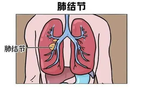 肺结节中医治疗