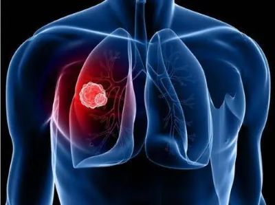 重庆治疗肺癌靠谱的中医馆是哪家?